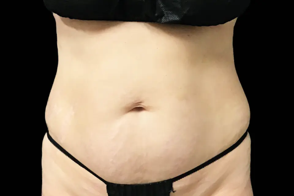 After EMSELLA treatment