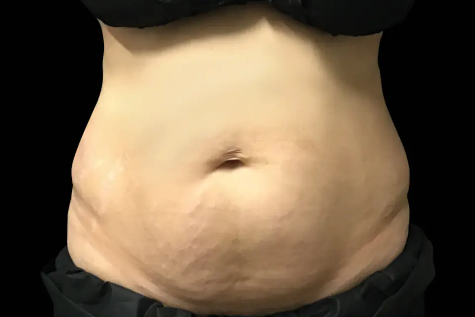 Before EMSELLA treatment