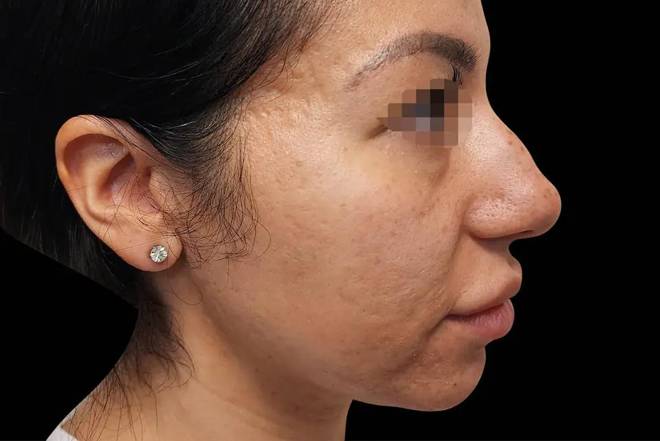 After EXION treatment
