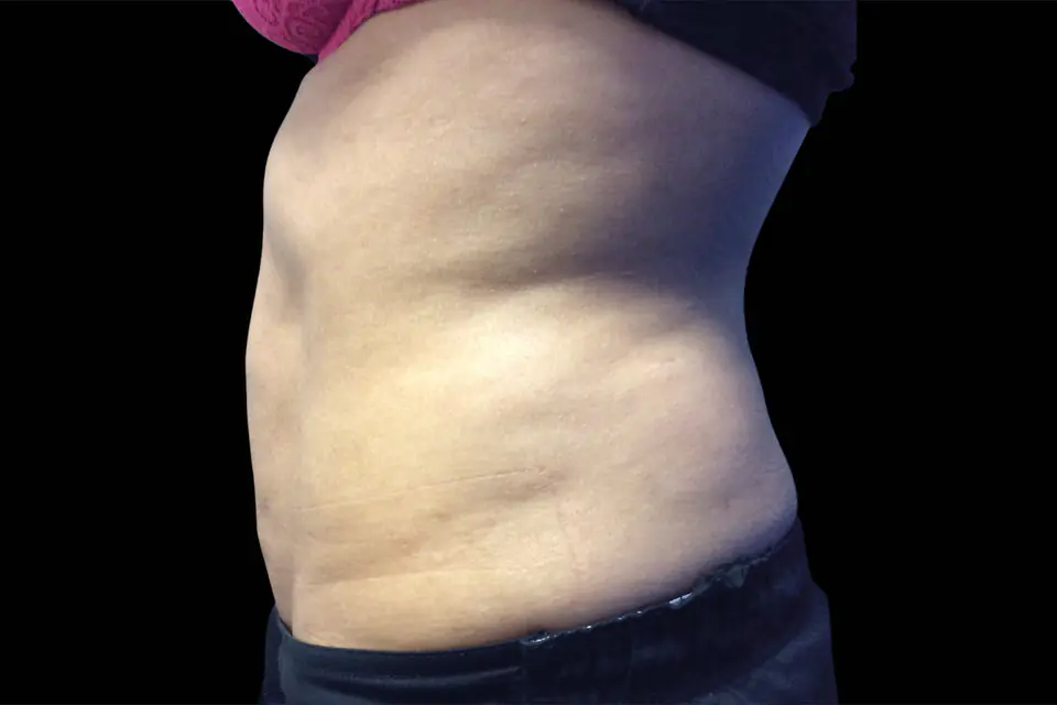 After Invisa-RED treatment