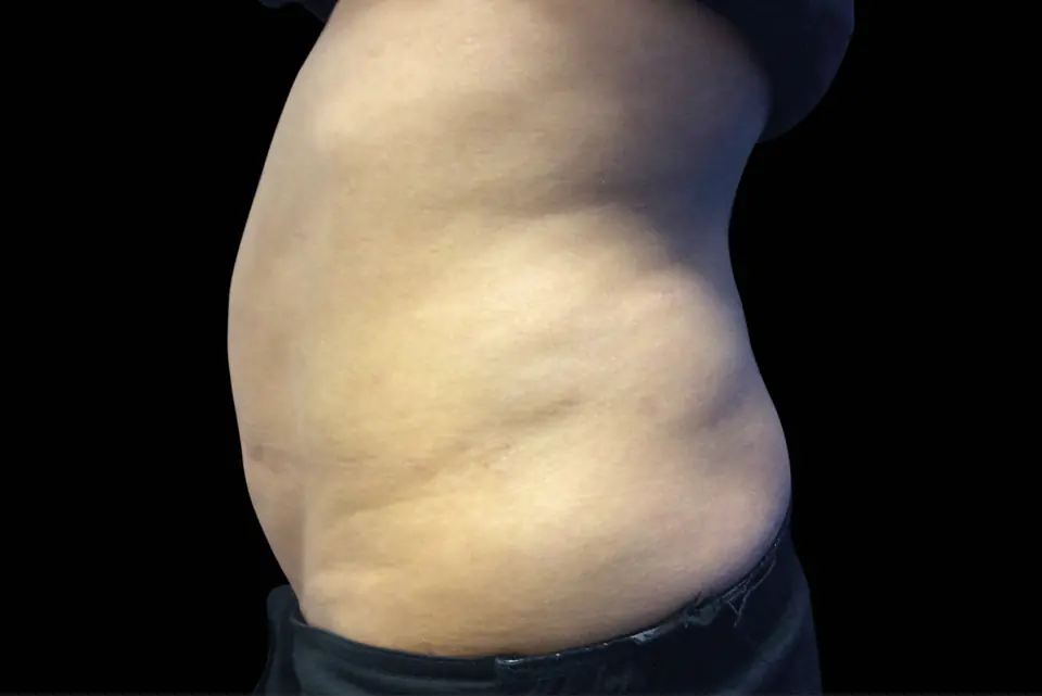 Before Invisa-RED treatment